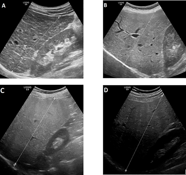 Understanding the Impact of Grade 3 Fatty Liver on Your Health π